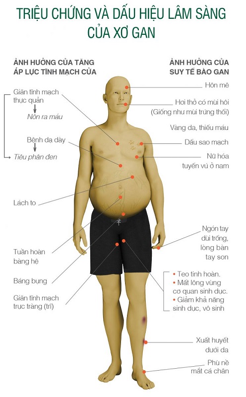 Đề tài: Nghiên cứu tình trạng rối loạn điện giải ở bệnh nhân xơ gan tại bệnh viện đa khoa Vị Xuyên năm 2021 - 2022